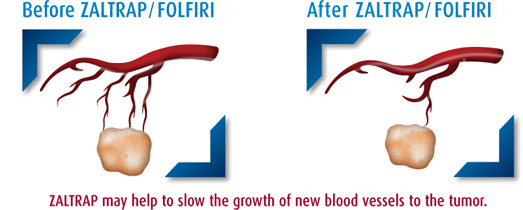 Tumor before and after treatment with ZALTRAP/FOLFIRI